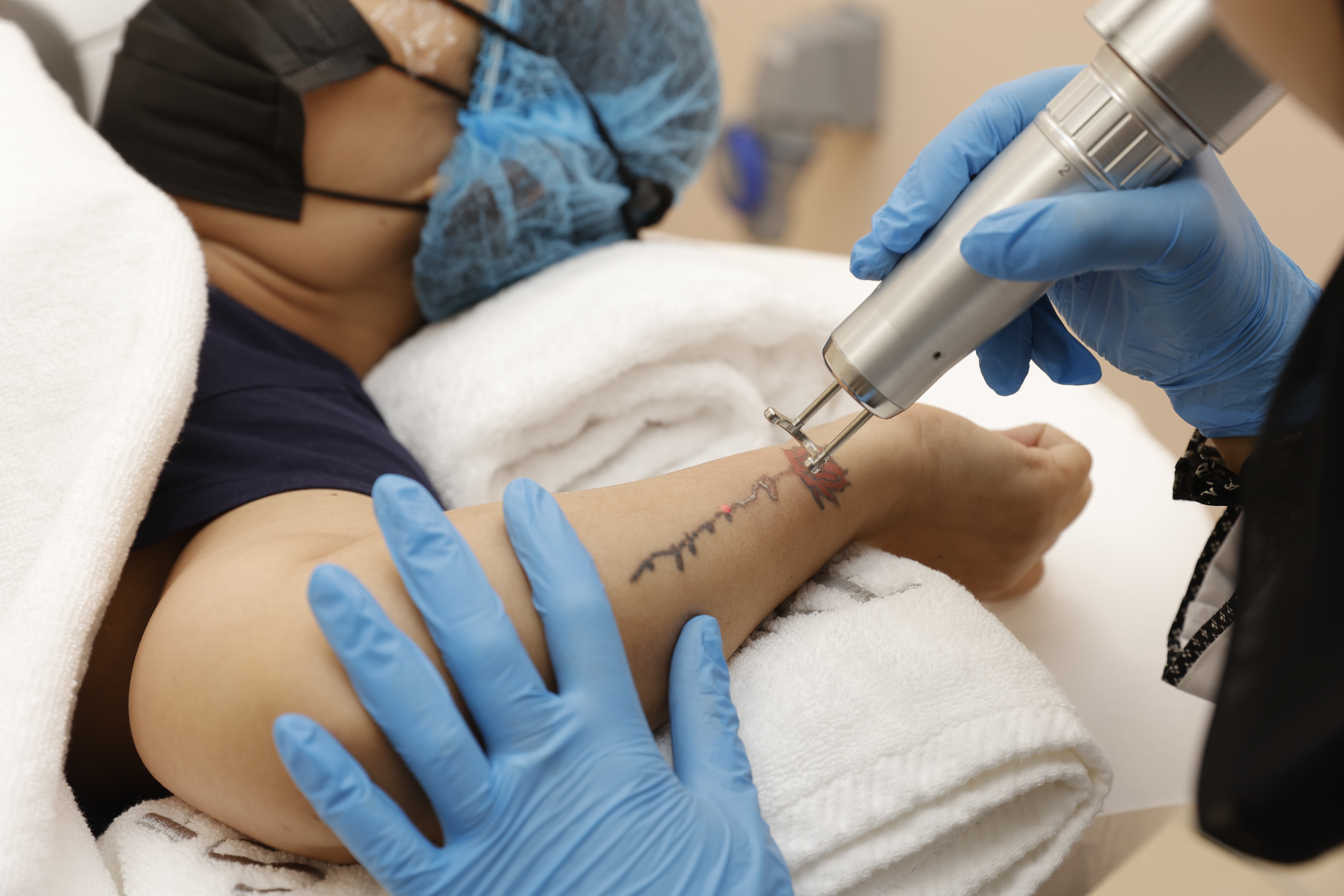 Laser tattoo removal treatment in Abu Dhabi